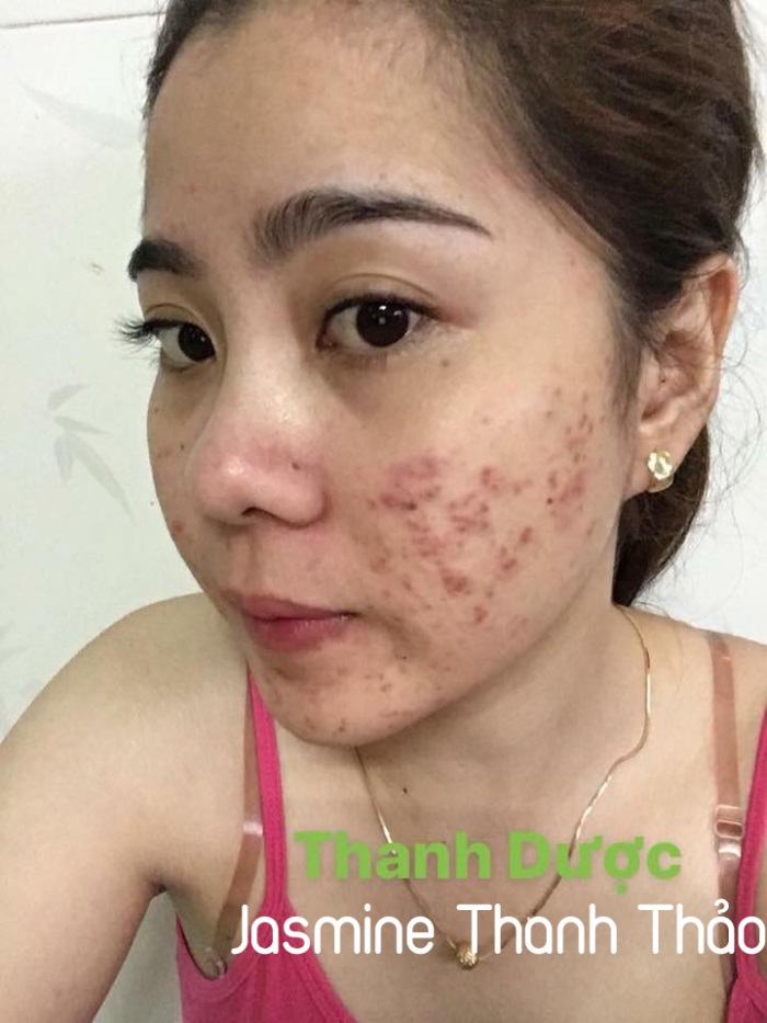 Mỹ phẩm đông y Thanh Dược - điều trị tận gốc mụn, nám, sẹo rỗ