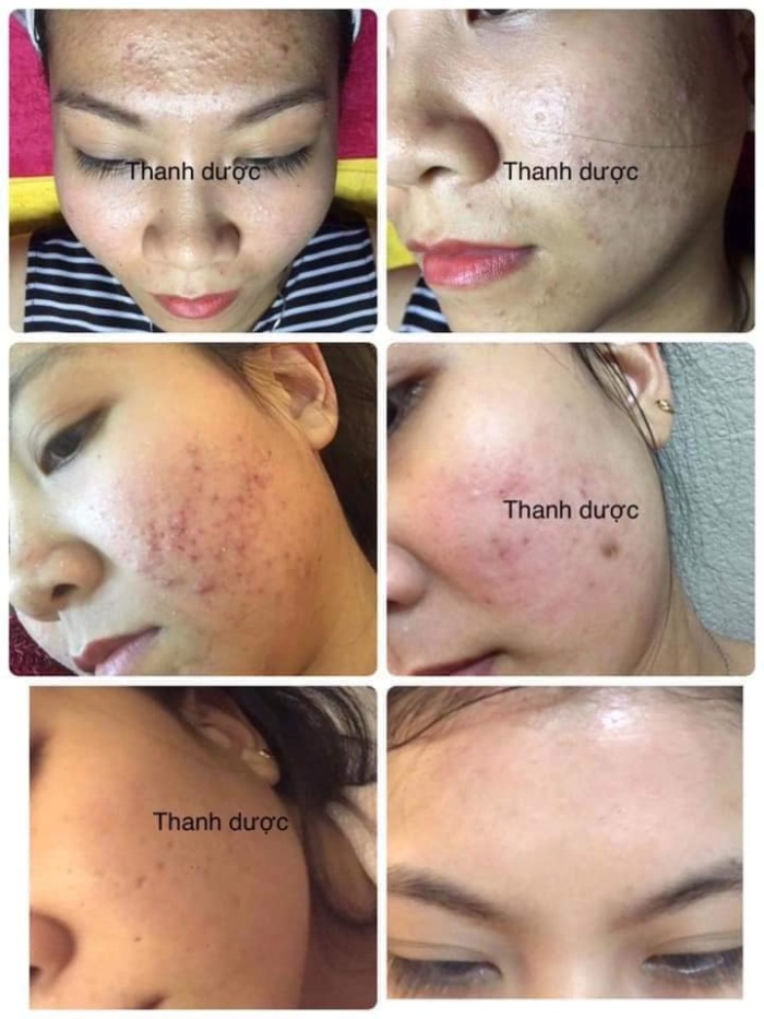 Mỹ phẩm đông y Thanh Dược - điều trị tận gốc mụn, nám, sẹo rỗ