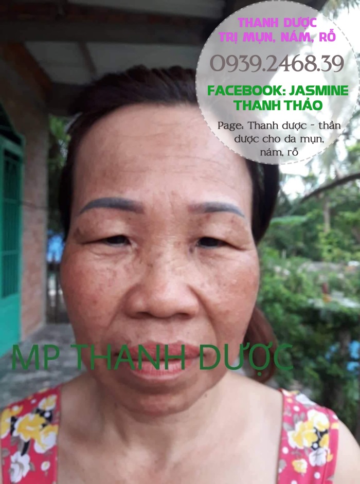 Mỹ phẩm đông y Thanh Dược - điều trị tận gốc mụn, nám, sẹo rỗ