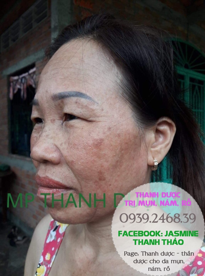 Mỹ phẩm đông y Thanh Dược - điều trị tận gốc mụn, nám, sẹo rỗ