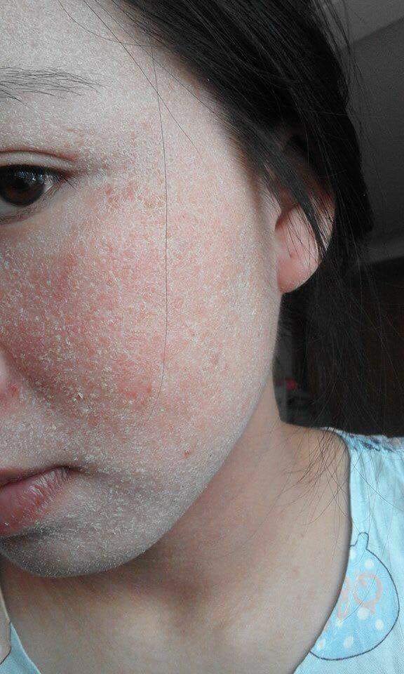 xử lý da khô khi dùng thanh dược