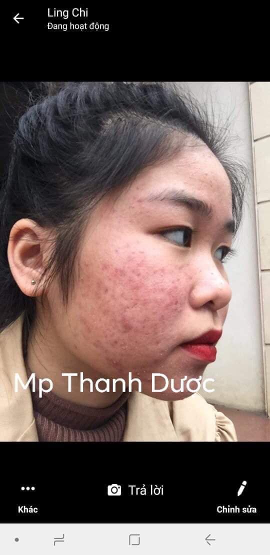 Serum trị mụn Thanh Dược 100% thiên nhiên