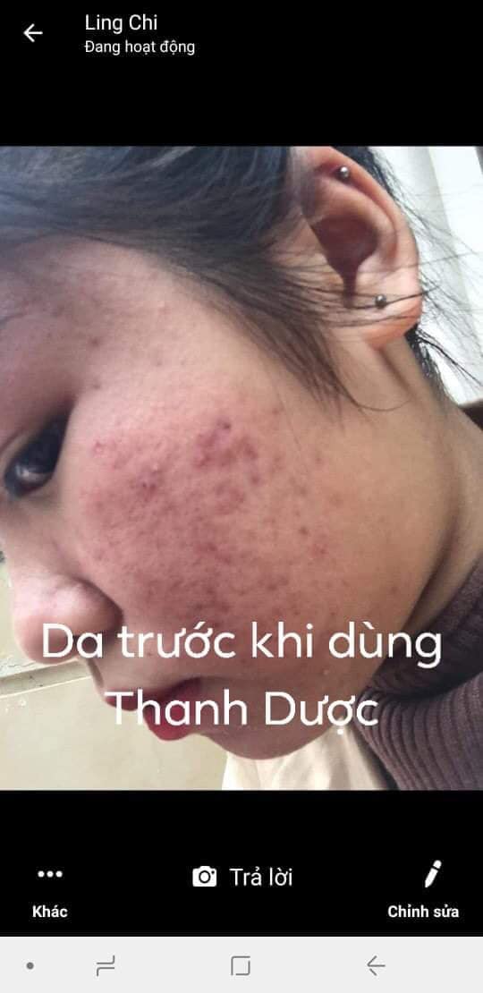 Serum trị mụn Thanh Dược 100% thiên nhiên