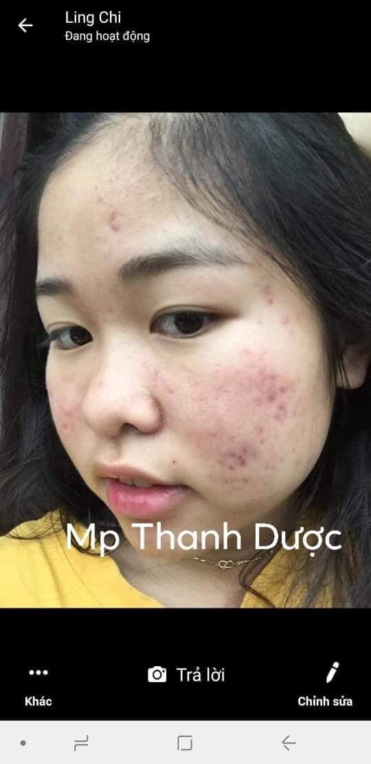 Serum trị mụn Thanh Dược 100% thiên nhiên