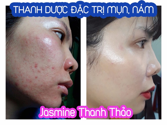 Serum Trị Mụn Thanh Dược