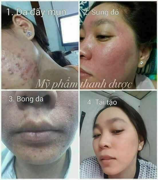 Serum trị mụn Thanh Dược 100% thiên nhiên