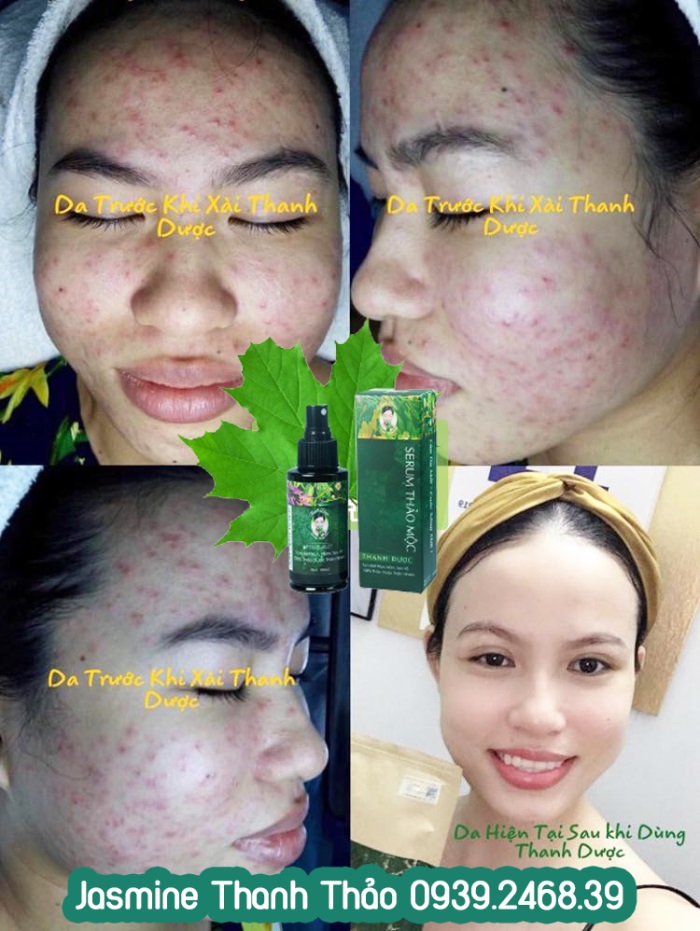 Serum trị mụn Thanh Dược 100% thiên nhiên