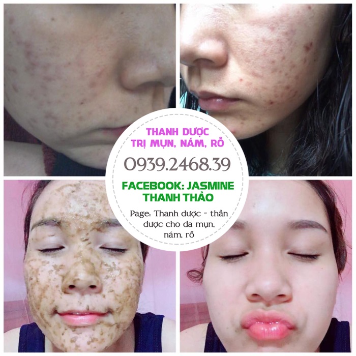 thanh dược trị mụn nám rỗ