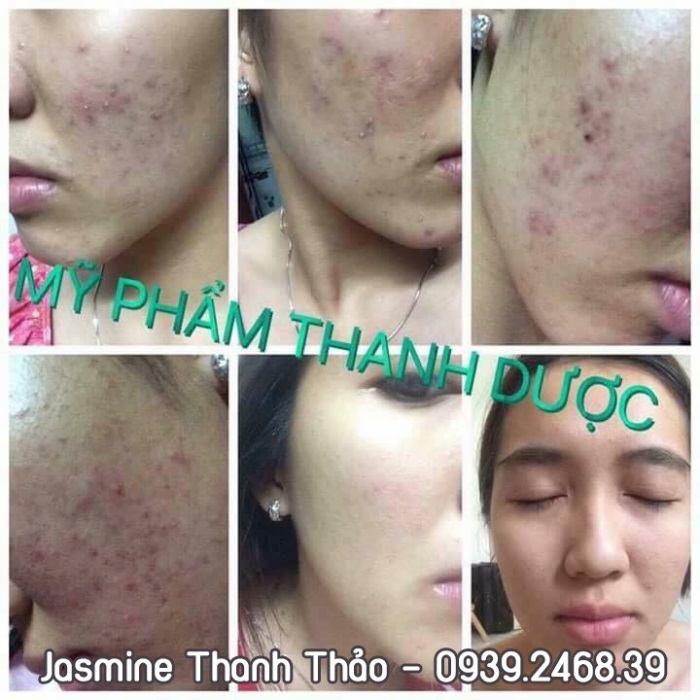 thanh dược trị mụn nám rỗ