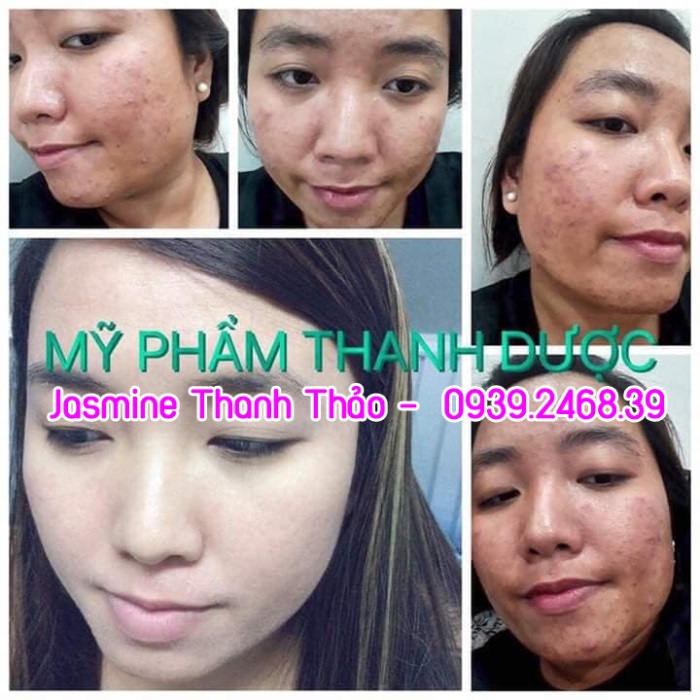 Serum Trị Mụn Thanh Dược