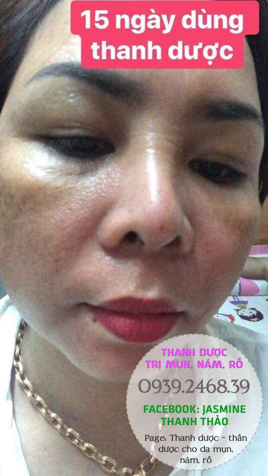 Serum Trị Mụn Thanh Dược