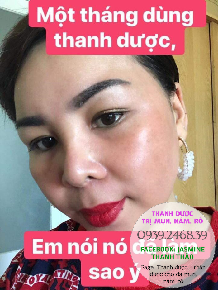 Serum Trị Mụn Thanh Dược