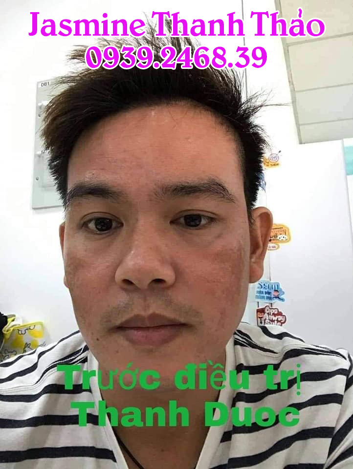 Serum Trị Mụn Thanh Dược