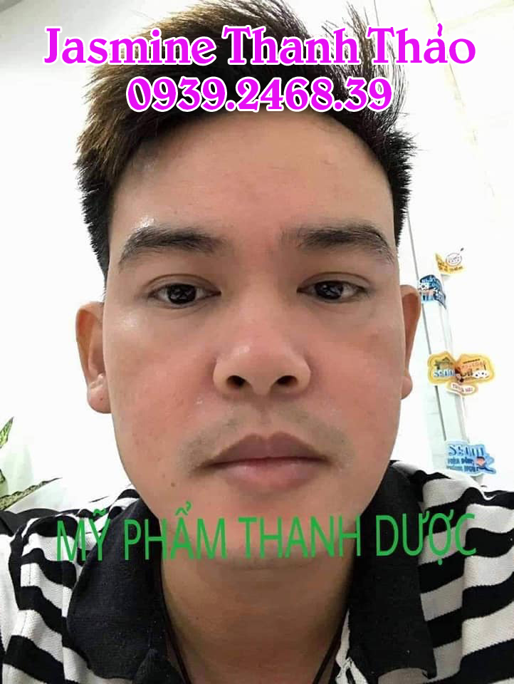 Serum Trị Mụn Thanh Dược