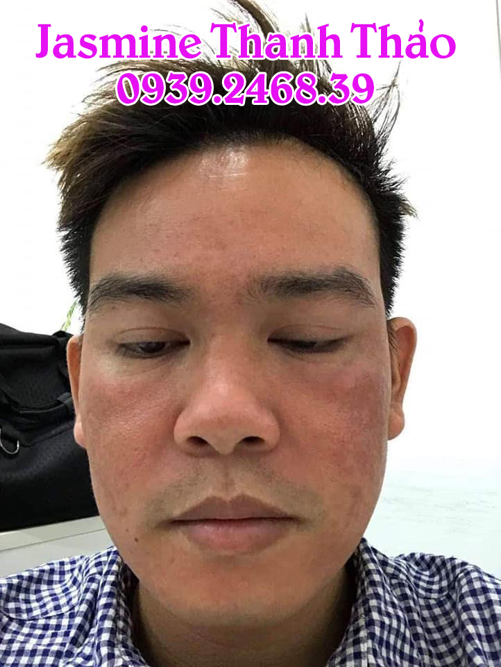 Serum Trị Mụn Thanh Dược