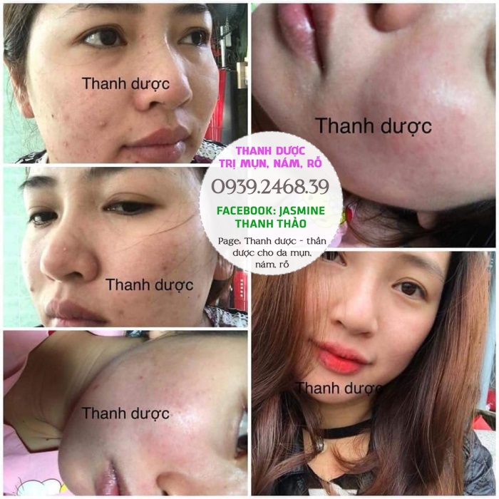 Thanh dược có điều trị mụn tận gốc hay không hay chỉ tạm thời?