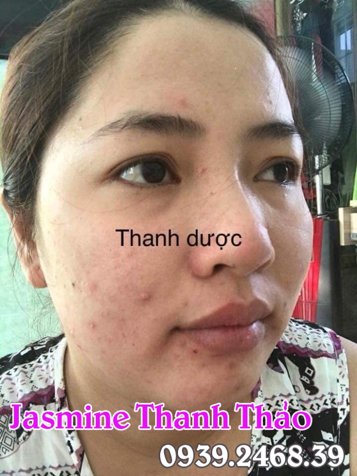 Thanh dược có điều trị mụn tận gốc hay không hay chỉ tạm thời?