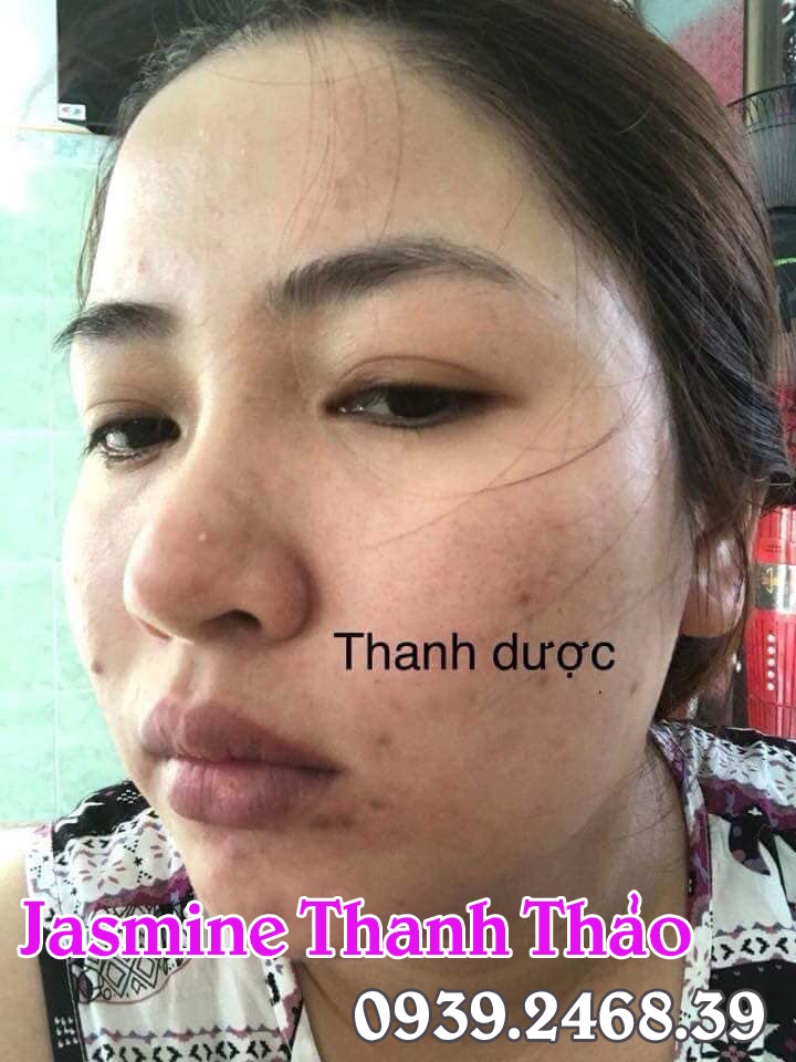 Thanh dược có điều trị mụn tận gốc hay không hay chỉ tạm thời?