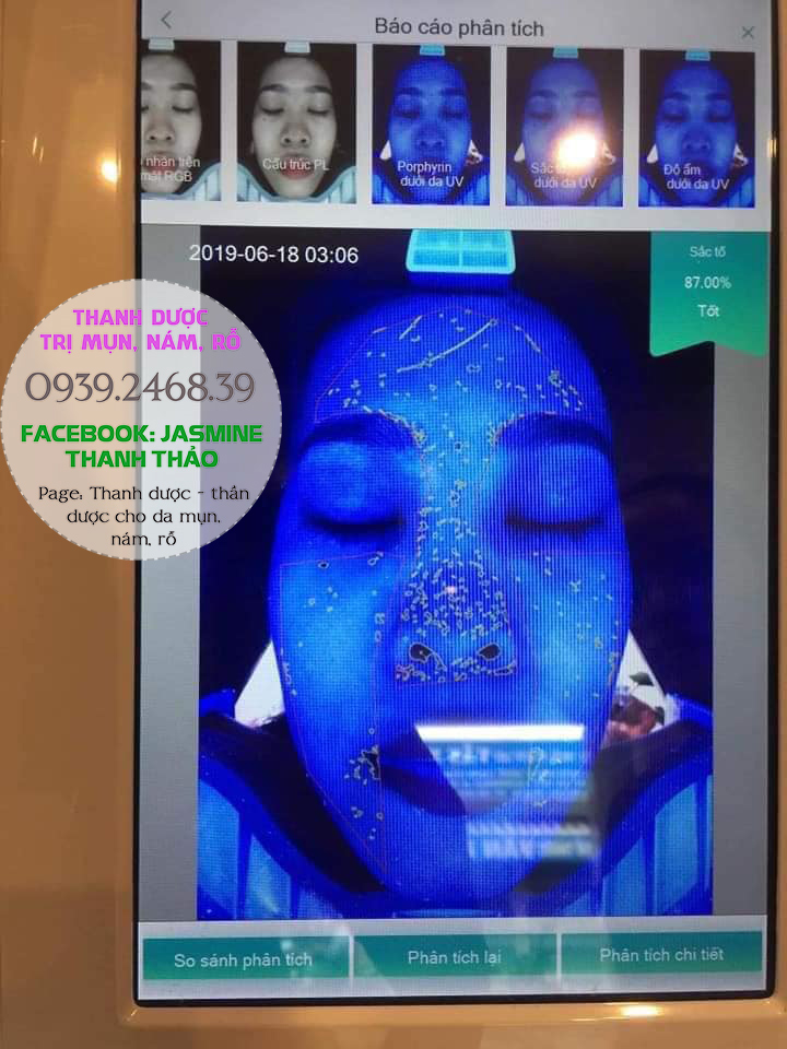 thanh dược trị mụn nám