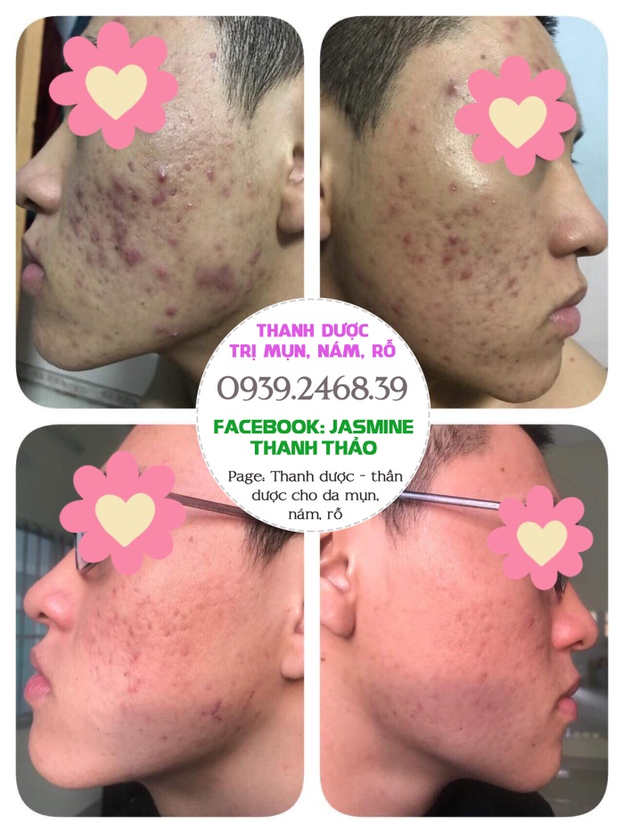 Dùng thanh dược bao lâu thì có kết quả