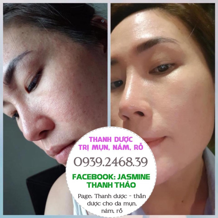 Serum trị mụn Thanh Dược 100% thiên nhiên