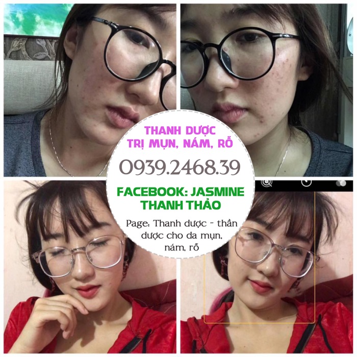 Mỹ phẩm đông y Thanh Dược - điều trị tận gốc mụn, nám, sẹo rỗ