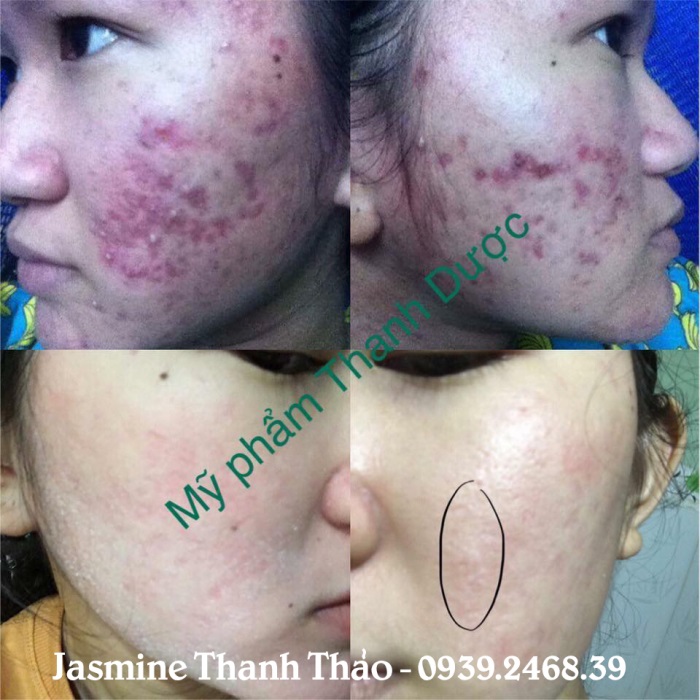 Serum trị mụn Thanh Dược 100% thiên nhiên