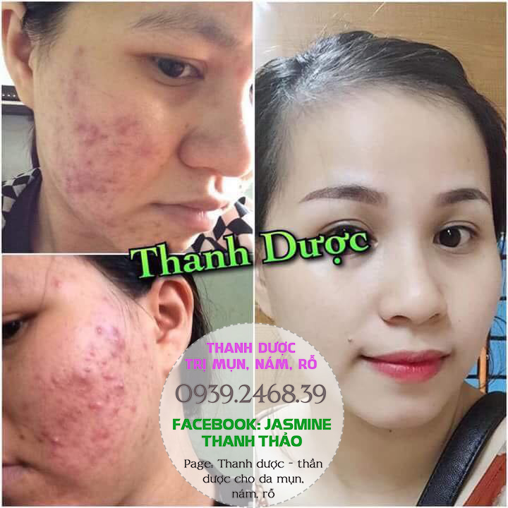 Serum trị mụn Thanh Dược 100% thiên nhiên