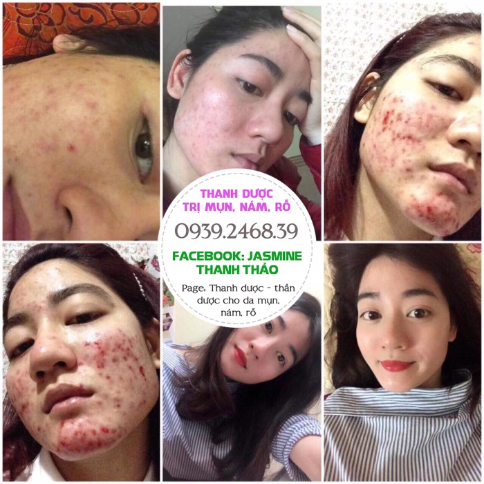 Sau khi sử dụng thanh dược mụn có tái phát không?