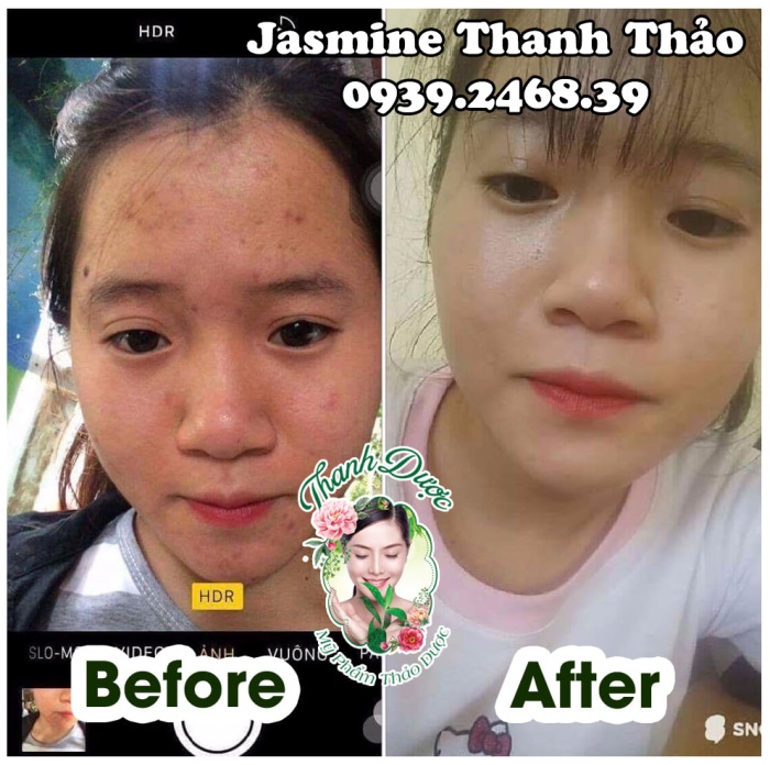 Mỹ phẩm trị mụn thanh dược có an toàn không?