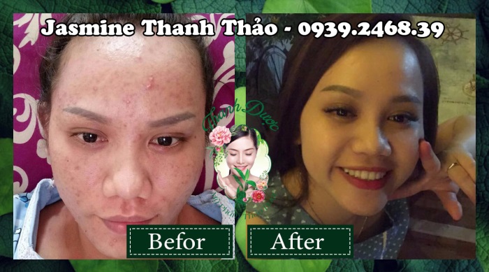 Mỹ phẩm trị mụn thanh dược có an toàn không?