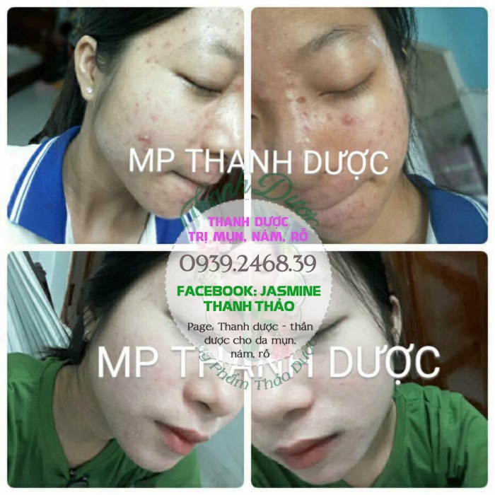 THANH DƯỢC TRỊ MỤN NÁM