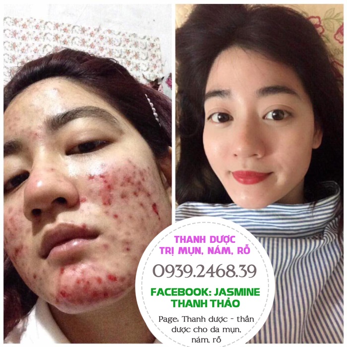 Serum trị mụn Thanh Dược 100% thiên nhiên