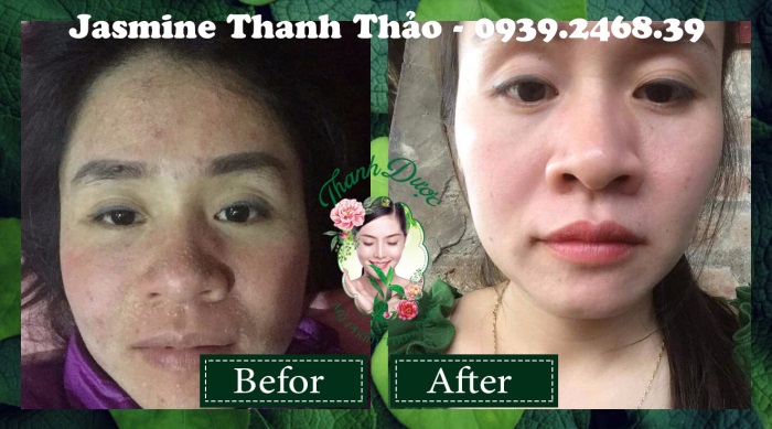 Thanh dược điều trị các vấn đề nào về da?
