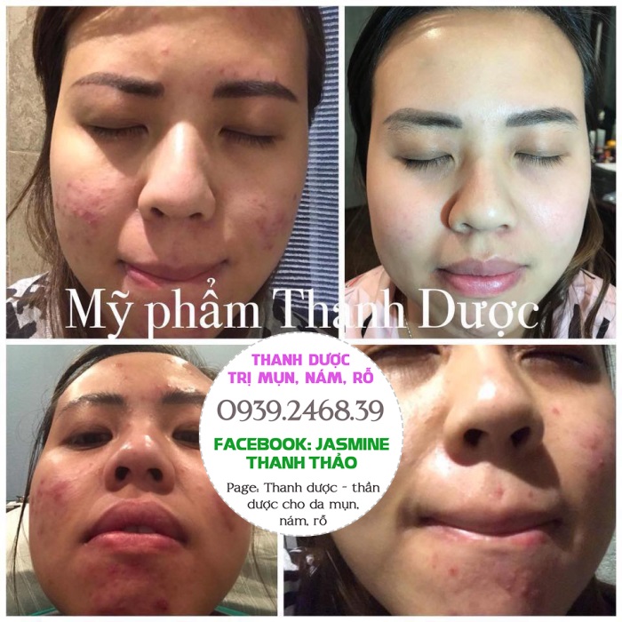 Thuốc trị mụn trứng cá cho da nhờn cam kết dứt điểm