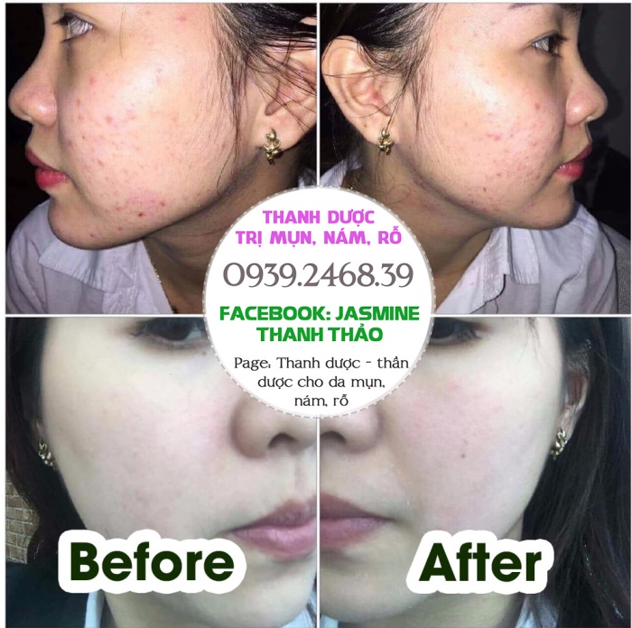 Thuốc trị mụn trứng cá cho da nhờn cam kết dứt điểm