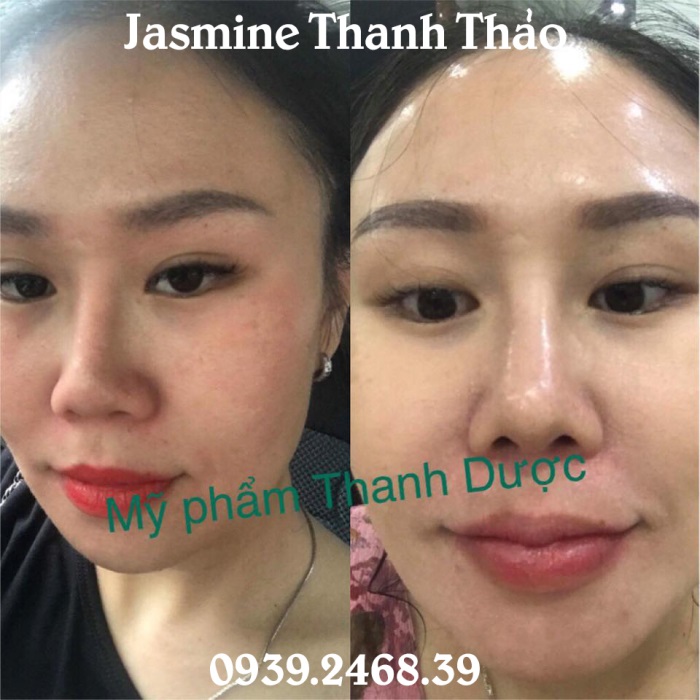 thuốc đặc trị mụn trứng cá tận gốc