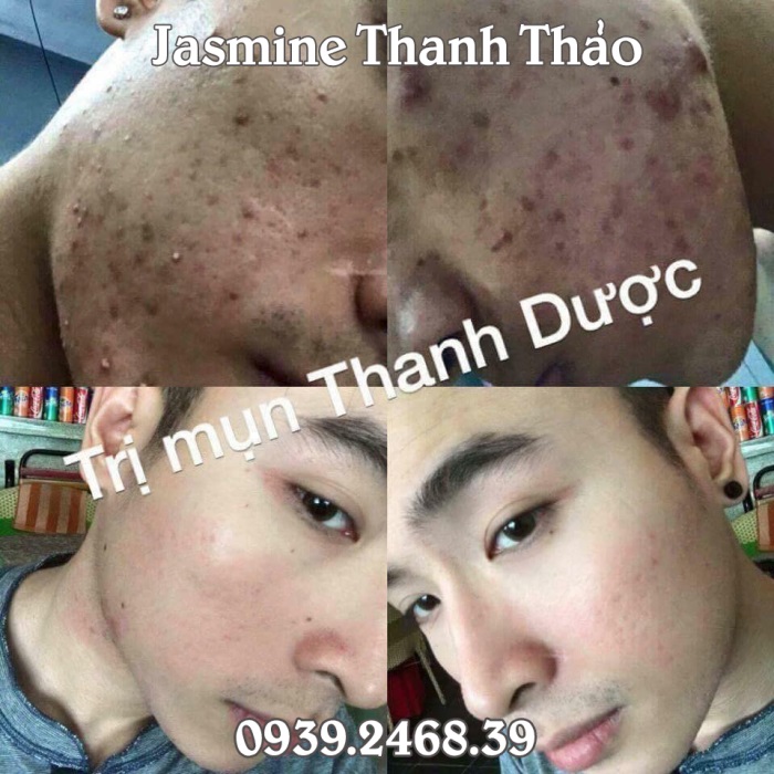 serum trị mụn trứng cá thanh dược