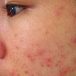 Triệu chứng nhận biết da nhiễm Corticoid và cách phục hồi