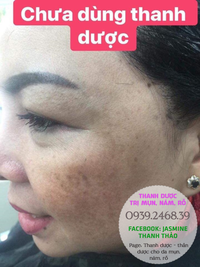 ĐẶC TRỊ NÁM THANH DƯỢC