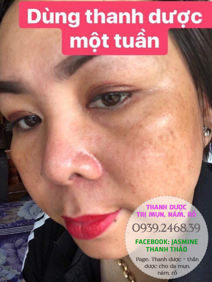 ĐẶC TRỊ NÁM THANH DƯỢC