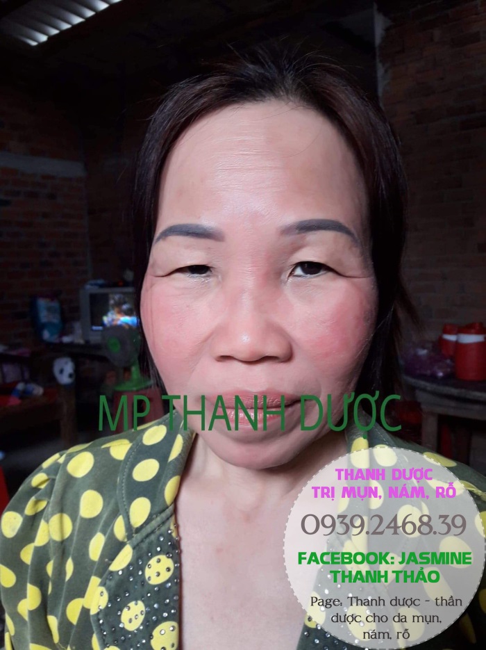 Serum trị nám thanh dược