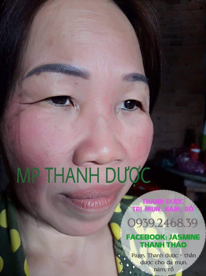Serum trị nám thanh dược