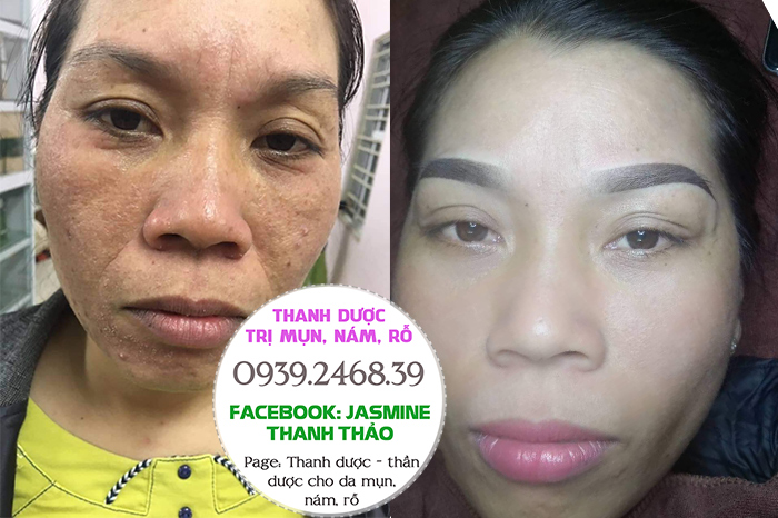 ĐẶC TRỊ NÁM THANH DƯỢC