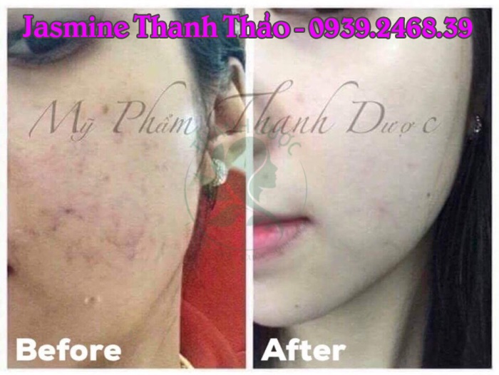 thanh dược trị da mỏng, lộ mao mạch