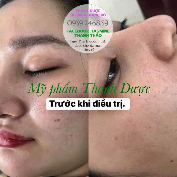 DÙNG THANH DƯỢC CÓ BÀO MÒN DA KHÔNG?