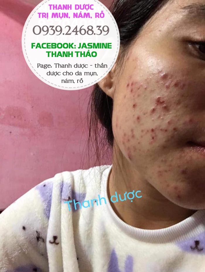 Dùng Thanh dược sau bao lâu thì có kết quả?