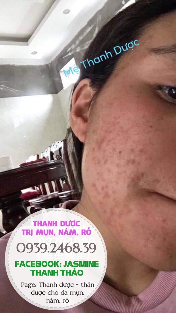 Dùng Thanh dược sau bao lâu thì có kết quả?