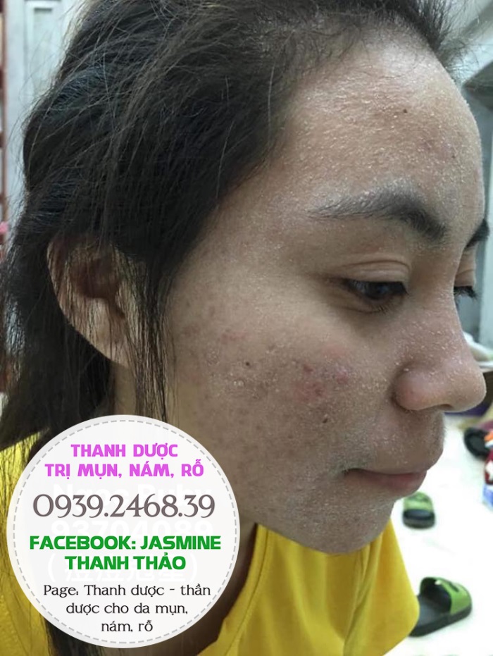 Dùng Thanh dược sau bao lâu thì có kết quả?