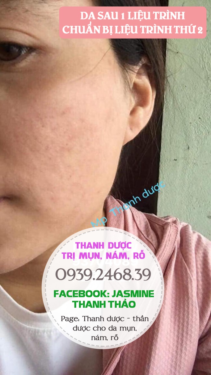 Dùng Thanh dược sau bao lâu thì có kết quả?